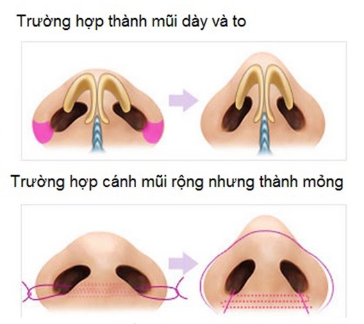 Thu gọn cánh mũi